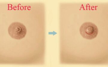 3 cách khắc phục núm vú bị tụt vào trong