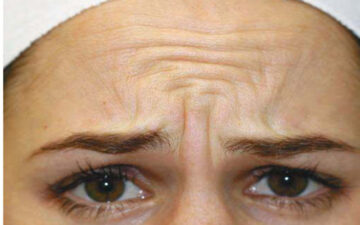 Nếp nhăn cau mày (Nguồn: Internet)