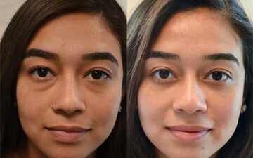 Cắt mí bao lâu thì đẹp? Hết sưng, lành hẳn trong bao lâu?