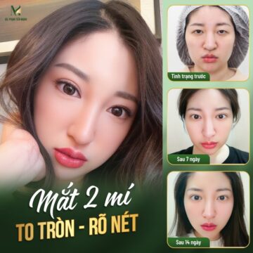 Trước và sau khi cắt mí đẹp tại MD Change Life (Nguồn: MD Change Life)