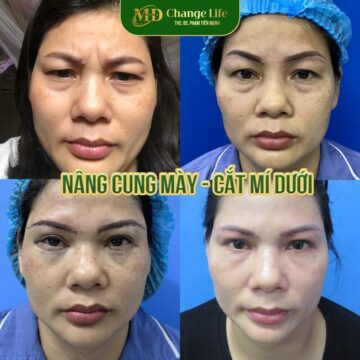 Thẩm mỹ MD Change Life- Địa điểm cắt mí dưới tại Nghệ An an toàn, uy tín hàng đầu (Nguồn: MD Change Life)
