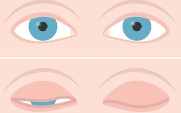 Cắt mí không nhắm được mắt phải làm sao?