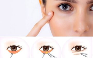 Cắt mí dưới (Nguồn: Internet)