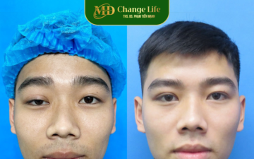 Sửa mí hỏng tại Thẩm mỹ MD Change Life (Nguồn: MD Change Life)