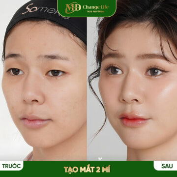 Trước và sau khi thực hiện phương pháp này tại Thẩm mỹ MD Change Life (Nguồn: Thẩm mỹ MD Change Life)