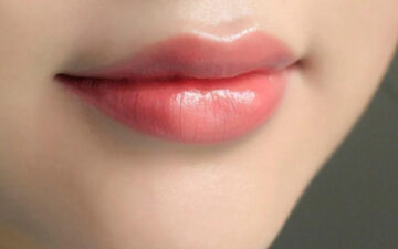 Cắt môi cười (Nguồn: Internet)