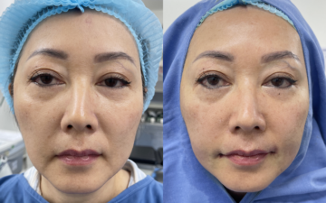 Cắt môi tự nhiên tại Thẩm mỹ MD Change Life (Nguồn: MD Change Life)