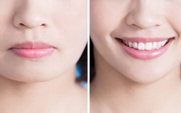 Tạo hình lại khóe môi tạo hiệu ứng môi cười tự nhiên ( Nguồn : Internet )