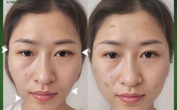 Mặt đầy đặn hơn sau cấy (Nguồn: MD Change Life)