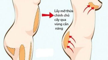 Cấy mỡ mông bằng mỡ tự thân là mỡ vùng bụng, đùi…. cấy vào vùng mông/ngực (Nguồn: Internet)