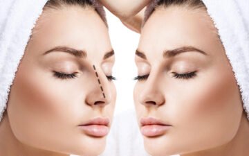 Mũi gãy do tai nạn gây mất thẩm mỹ (Nguồn: Internet)