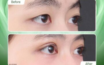 Chỉnh mí mắt tại Thẩm mỹ MD Change Life (Nguồn: Thẩm mỹ MD Change Life)