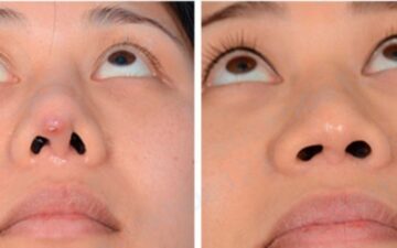 Tình trạng mũi bị lộ sụn, bóng đỏ đầu mũi (Nguồn: Internet)