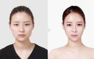 Có nên tiêm gọn hàm không? Lời khuyên từ chuyên gia