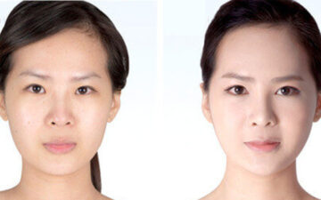 Giá cấy mỡ tự thân lên mặt 2024