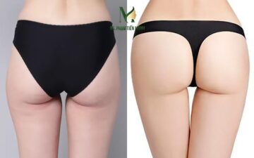 Nâng mông tại Thẩm mỹ MD Change Life (Nguồn: MD Change Life)