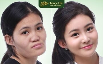 Gọt hàm, hạ gò má tại Thẩm mỹ MD Change Life (Nguồn: Internet)