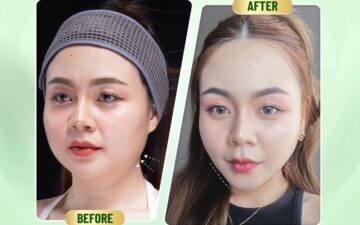 5 địa chỉ gọt hàm Hà Nội uy tín nhất