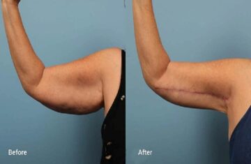 Đến Thẩm mỹ MD Change Life để được hút mỡ bắp tay với mức giá hợp lý (Nguồn: Internet)