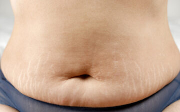 Hậu quả của hút mỡ bụng bị lồi lõm (Nguồn: Internet)