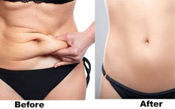 Việc hút mỡ có nguy hiểm không phụ thuộc nhiều vào việc hiểu rõ những yếu tố chống chỉ định cho phẫu thuật hút mỡ (Nguồn: Internet)