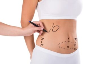 Top 8 địa chỉ hút mỡ uy tín nhất tại Nghệ An – Giúp bạn lấy lại vóc dáng mơ ước