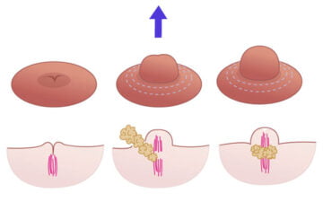 Núm vú tụt là tình trạng núm vú nằm sâu bên trong ngực và có thể khắc phục bằng phương pháp kéo núm vú tụt (Nguồn: Internet)