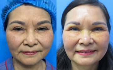 Xóa nếp cau mày tại MD Change Life (Nguồn: Thẩm Mỹ MD Change Life)