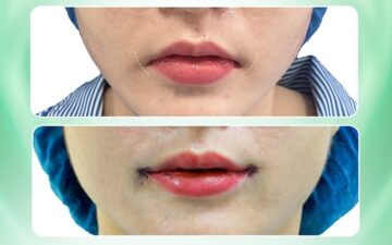 Làm khoé miệng cười tại Thẩm mỹ MD Change Life (Nguồn: MD Change Life)