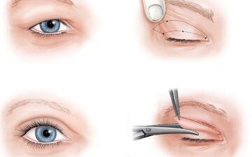 Phương pháp cắt cơ hỗ trợ nâng mí mắt (Nguồn: Internet)
