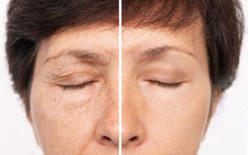 Nâng cung chân mày là một kỹ thuật thẩm mỹ nhằm điều chỉnh vị trí của cung chân mày, giúp khuôn mặt trông cân đối, hài hòa và trẻ trung hơn (Nguồn: Internet)