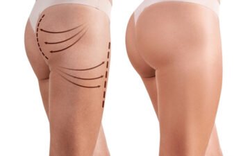 Những ai nên thực hiện nâng mông? (Nguồn: Internet)