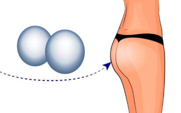 Nâng mông nội soi (Nguồn: Internet)