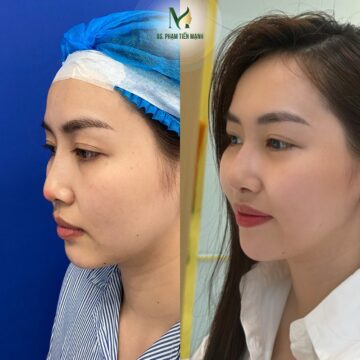 Nâng mũi bán cấu trúc tại Thẩm Mỹ MD Change Life (Nguồn: MD Change Life)