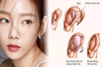 Nâng mũi bọc sụn - phương pháp sửa mũi phổ biến (Nguồn: Internet)