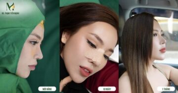 Nâng mũi cấu trúc 4D là một phương pháp phẫu thuật mũi tiên tiến, nâng cao và đa chiều (Nguồn: MD Change Life)