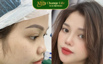 MD Change Life: Địa chỉ nâng mũi cấu trúc 4D Hà Nội (Nguồn: MD Change Life)