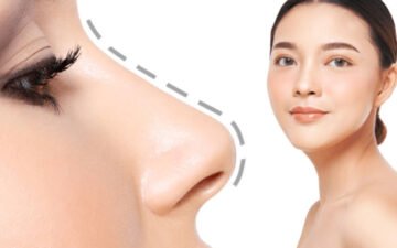 Chăm sóc sau khi nâng mũi Surgiform (Nguồn: Internet)