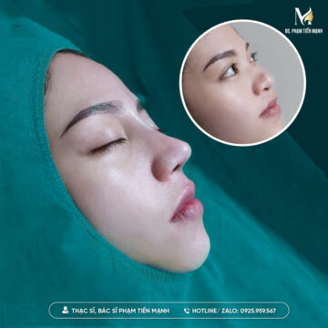 Đến với Thẩm mỹ MD Change Life để được sửa mũi Surgiform (Nguồn: MD Change Life)