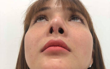 Dấu hiệu của nâng mũi lòi sụn (Nguồn: Internet)