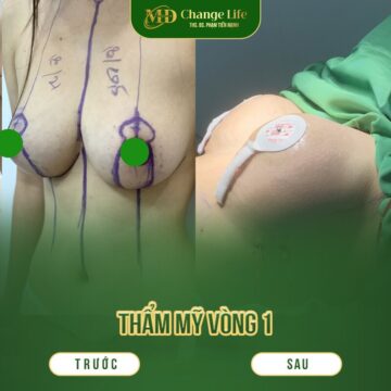 Thẩm mỹ MD Change Life - Địa điểm cải thiện vòng một uy tín tại Hà Nội (Nguồn: MD Change Life)