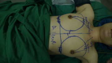 Thẩm mỹ MD Change Life - Địa điểm uy tín để bạn thực hiện phẫu thuật nâng ngực chuyển giới (Nguồn: MD Change Life) 