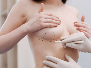 Nâng ngực sửa lại là phương pháp điều chỉnh hình dáng và kích thước vòng 1 bằng cách sử dụng các túi độn (Nguồn: Internet)