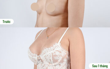 Thẩm mỹ MD Change Life – Địa chỉ nâng ngực túi Mentor Hà Nội hoàn hảo