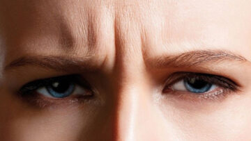 Nếp nhăn giữa 2 chân mày là gì? (Nguồn: Internet)