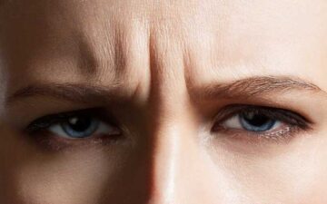 Người có nếp nhăn sâu ở giữa trán cần phẫu thuật cắt cơ cau mày (Nguồn: Internet)