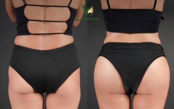 Phẫu thuật nâng mông tại Thẩm mỹ MD Change Life (Nguồn: MD Change Life)