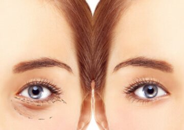 Cắt mí dưới là một thủ thuật thẩm mỹ nhằm loại bỏ bọng mỡ, da thừa và nếp nhăn dưới mắt, giúp tạo ra vẻ ngoài trẻ trung hơn (Nguồn: Internet)