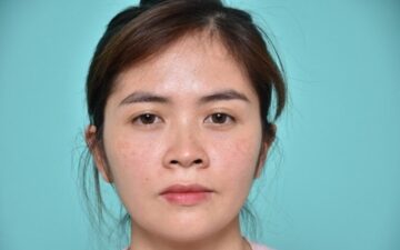 Tình trạng mũi hếch (Nguồn: Internet)