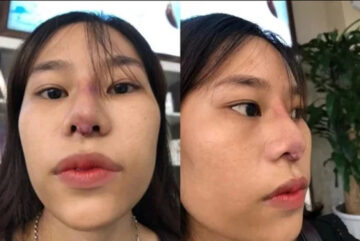 Dấu hiệu mũi bị hỏng sau khi thực hiện nâng mũi (Nguồn: Internet)
